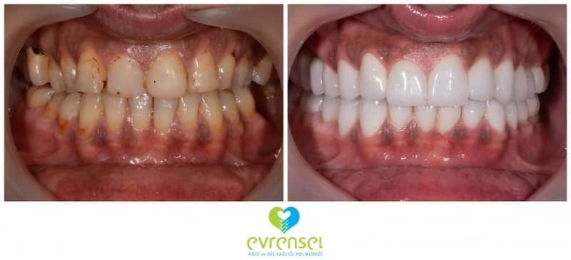 Slider image (8) Evrensel Dental Clinic in Ankara Turkey